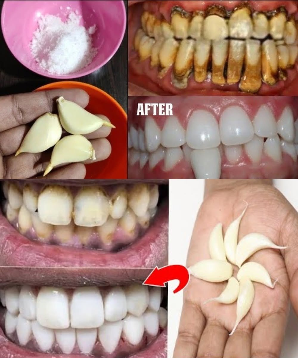 Teeth Whitening at Home in 3 Minutes What Actually Work and What to Avoid